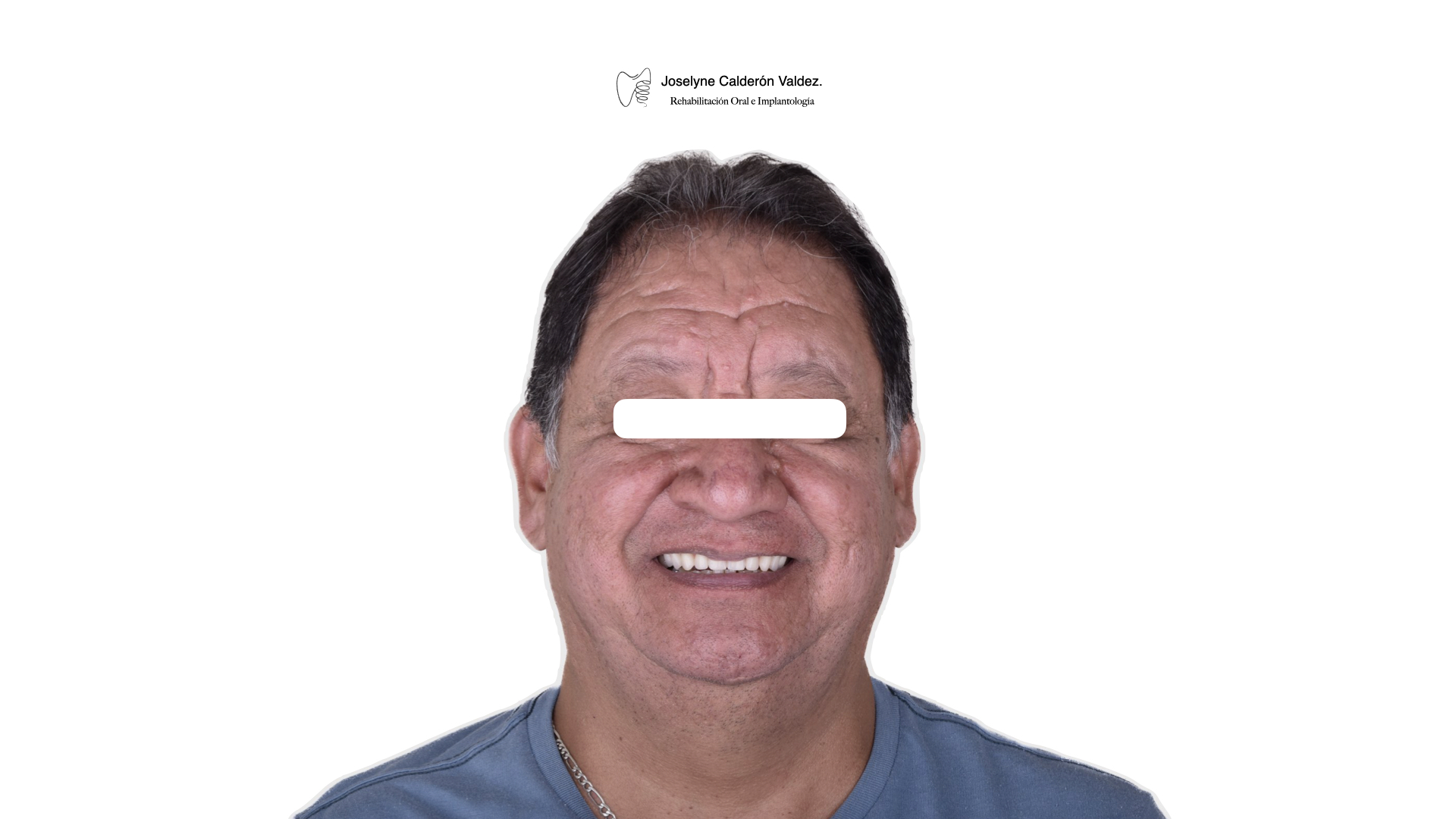 Después de restauración dental