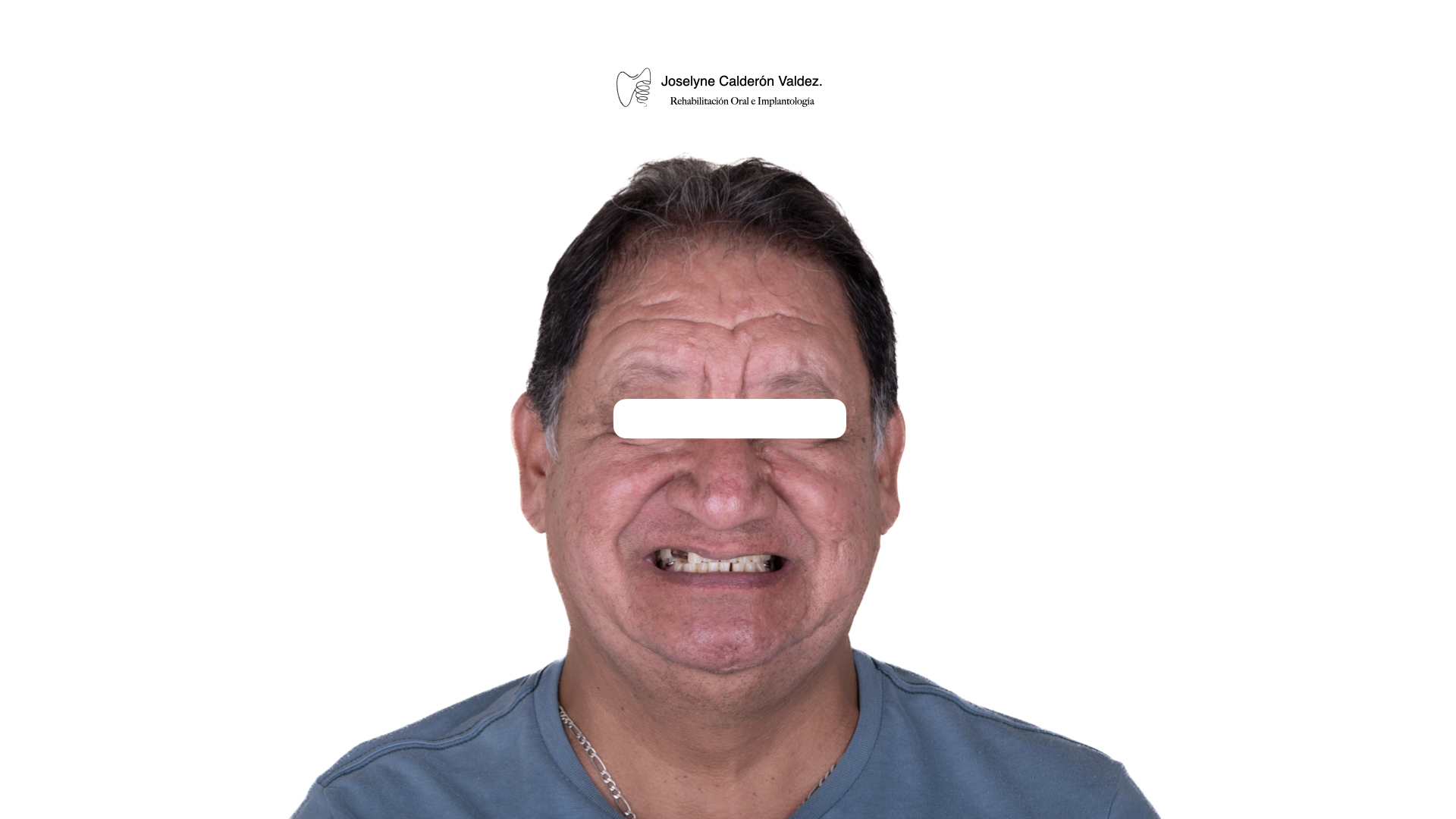 Antes de restauración dental