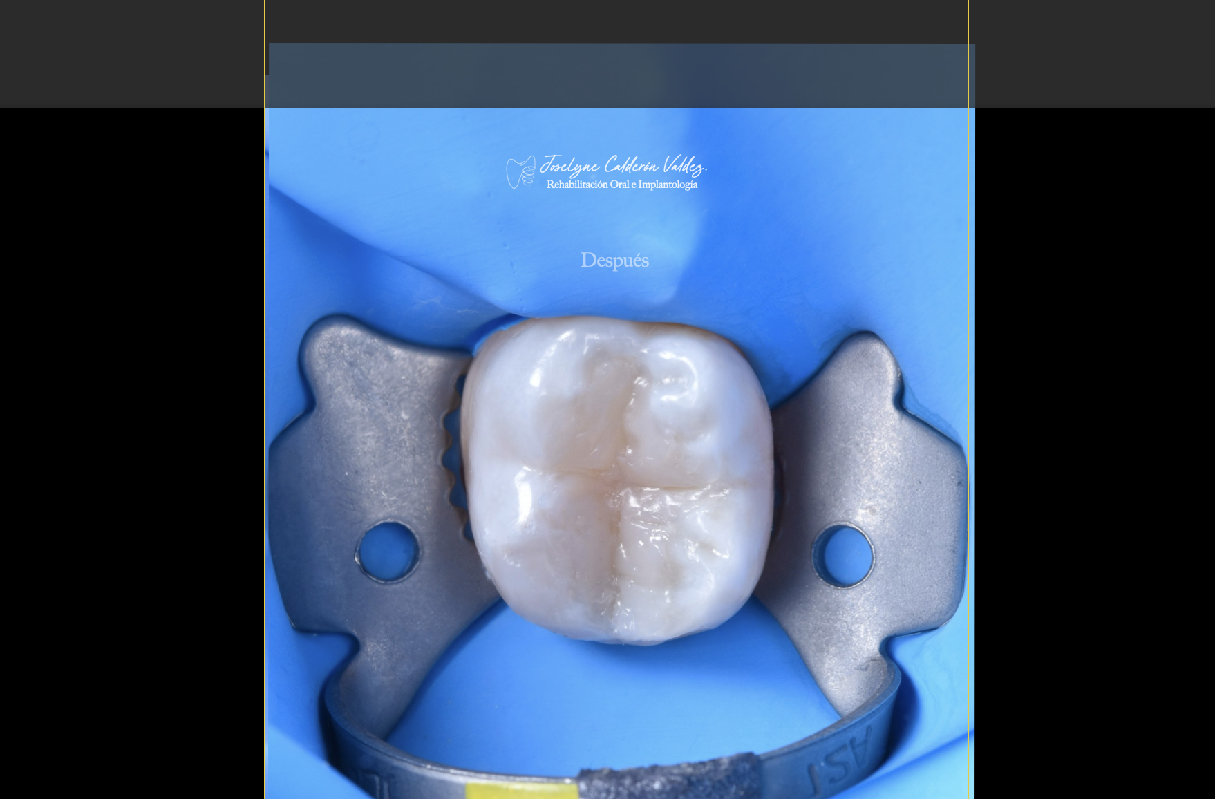 Restauración dental finalizada