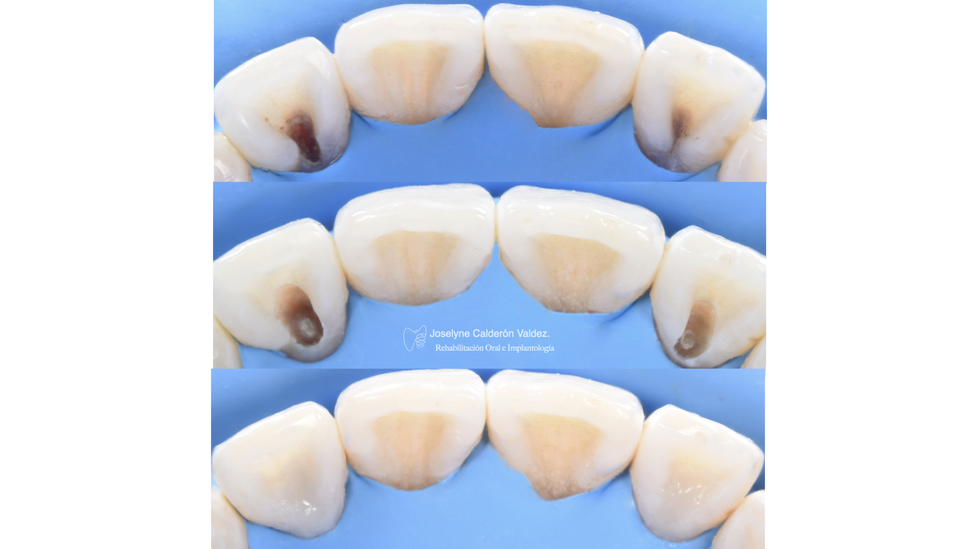 Secuencia clínica de restauración dental